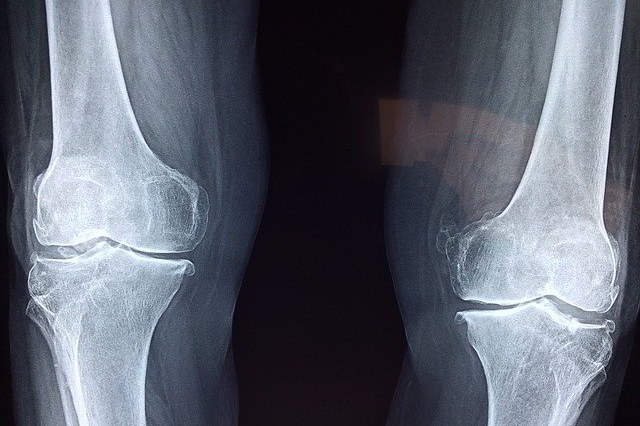Prevence osteoporózy